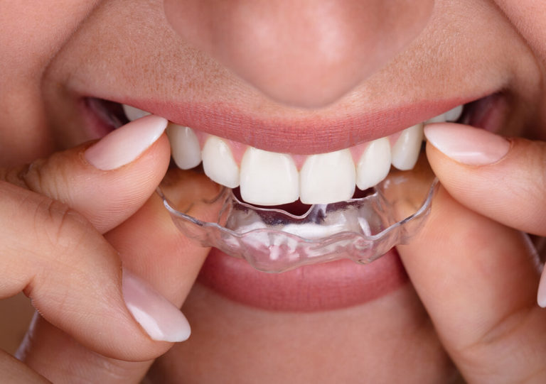 USE CLEAR ALIGNERS TO IMPROVE SMILE ALIGNMENT