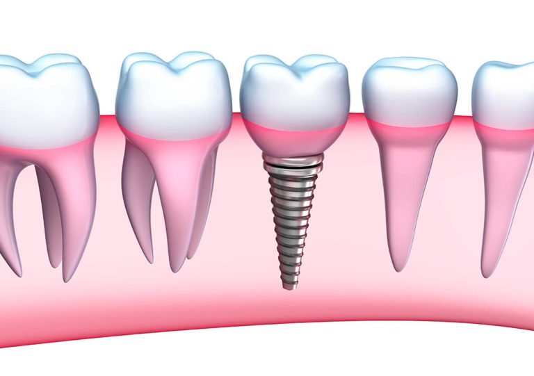 WHY DENTAL IMPLANTS ARE THE BEST CHOICE FOR REPLACING TEETH