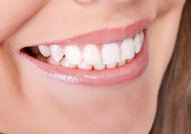 WHITEN YOUR SMILE WITH DENTAL-GRADE BLEACHING OPTIONS