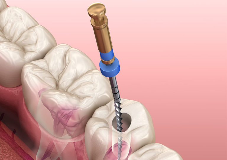 WHEN IS ROOT CANAL THERAPY A BETTER CHOICE THAN EXTRACTION?