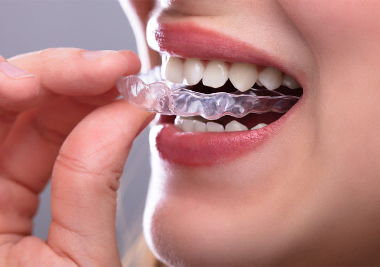 CORRECT BAD BITE AND CROOKED TEETH WITH INVISALIGN INVISIBLE DENTAL ALIGNERS