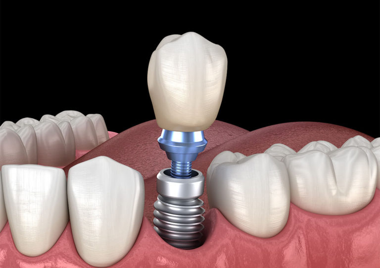 EXPERIENCED DENTIST SHARES THE PROCESS FOR TEETH IMPLANTS