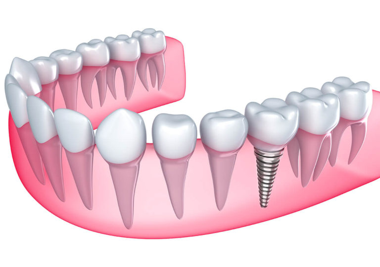 RESTORE YOUR SMILE WITH TOOTH IMPLANT PROCEDURE