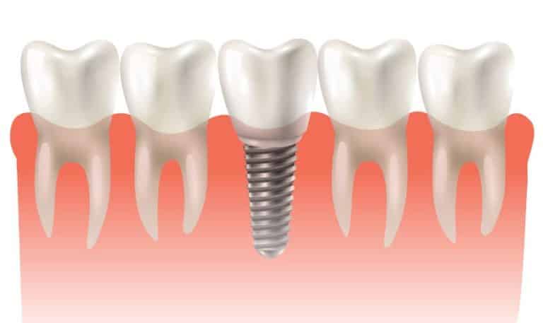 Dental Implants: The Long-Term Solution to Missing Teeth and Their Benefits