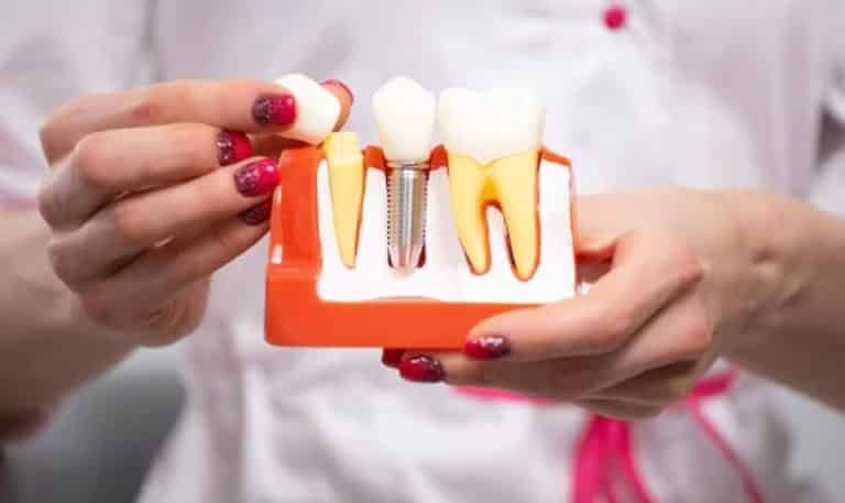 Unlocking the Benefits of Dental Implants: Your Ultimate Guide to a Healthy Smile