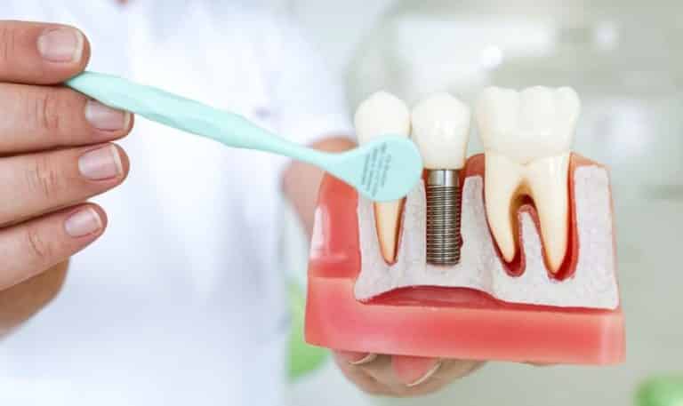 The Ultimate Guide to Dental Implant Care: Expert Tips for Long-Term Success
