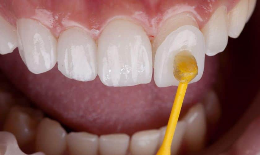 Porcelain Veneers Can Transform Your Smile