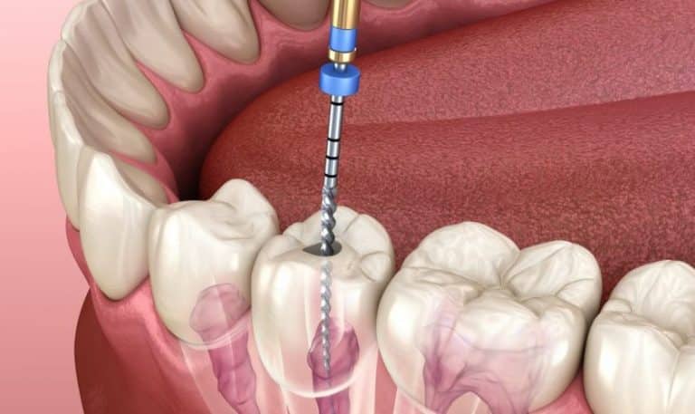 The Ins and Outs of Root Canal Treatment: What You Need to Know