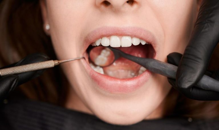 Say Goodbye to Silver Fillings: The Benefits of Tooth-Colored Fillings
