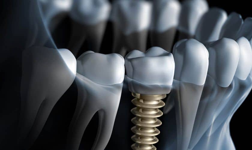 Dental Implants in Northside Richmond VA