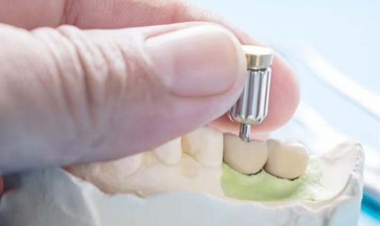 Implant in an Instant: The Marvel of Same-Day Dental Implants