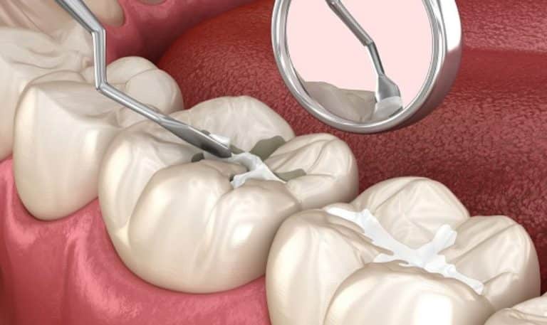 The Art of Invisible Repair: Unveiling Tooth-Colored Fillings