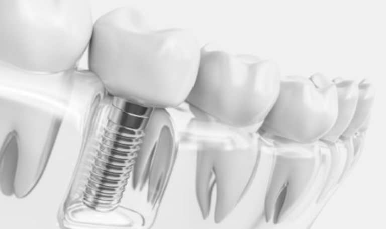 The Importance of Proper Oral Hygiene in the First Days with Dental Implants