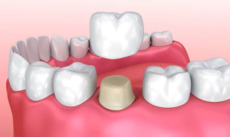 Pros and Cons of Porcelain Crowns: Is It the Right Choice for You?