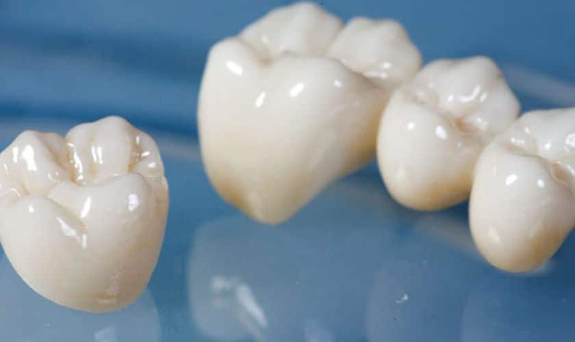 Porcelain Crowns in Staples Mill Richmond