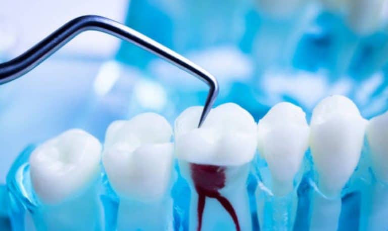 How to Prepare for a Smooth and Successful Root Canal Procedure
