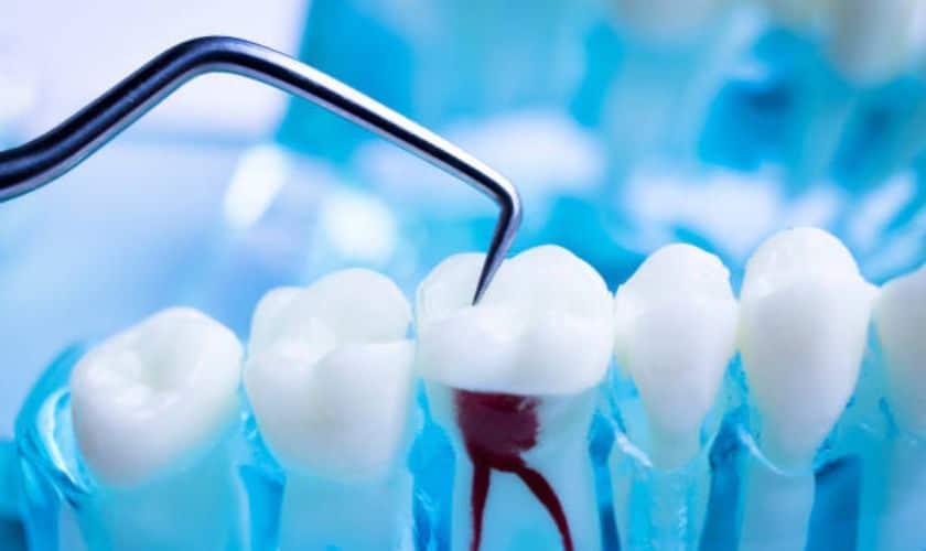 Root Canals in Southside Richmond, VA