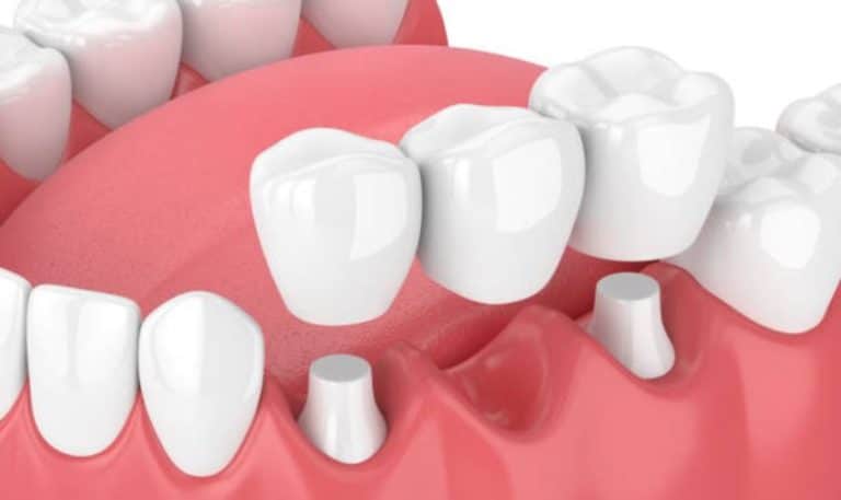 Maintaining Long-lasting Porcelain Dental Crowns in Southside Richmond, VA