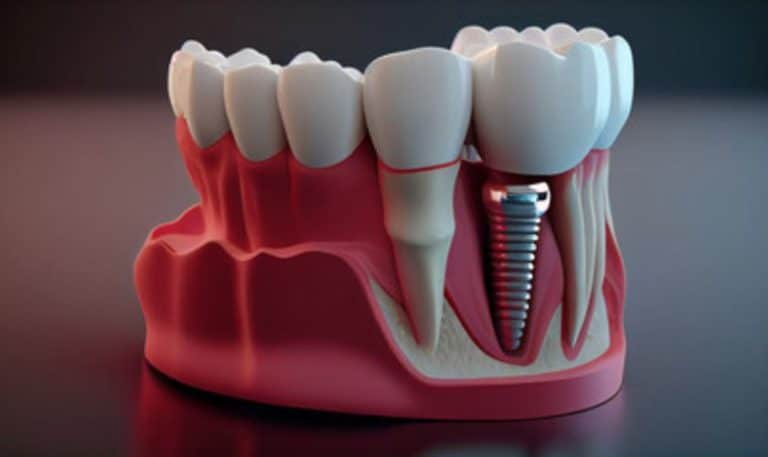 Choosing Between Titanium and Zirconia Dental Implants: Which Material is Right for You?