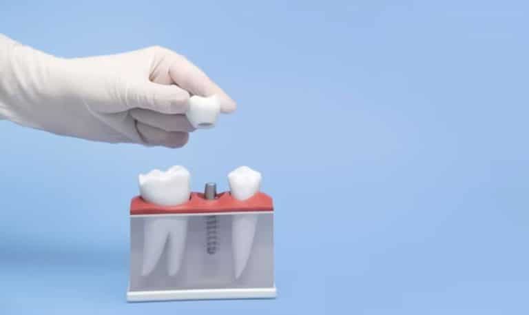 Must-Have Oral Hygiene Products for Maintaining Dental Implants
