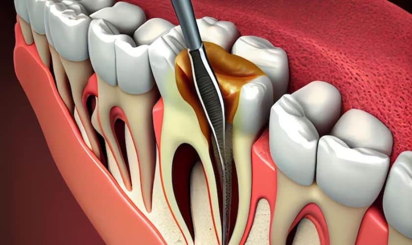Root Canal in Staples Mill Richmond, VA