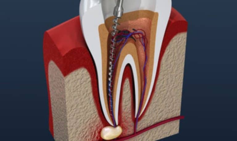Signs and Symptoms: When Do You Need a Root Canal Treatment?