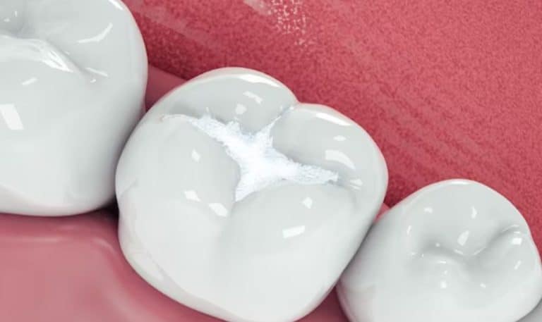 Why Tooth-Colored Fillings are Gaining Popularity: Pros and Cons Unveiled