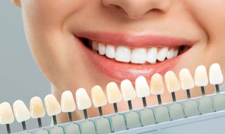 Why Porcelain Veneers are the Perfect Solution for Dental Imperfections in Northside Richmond, VA