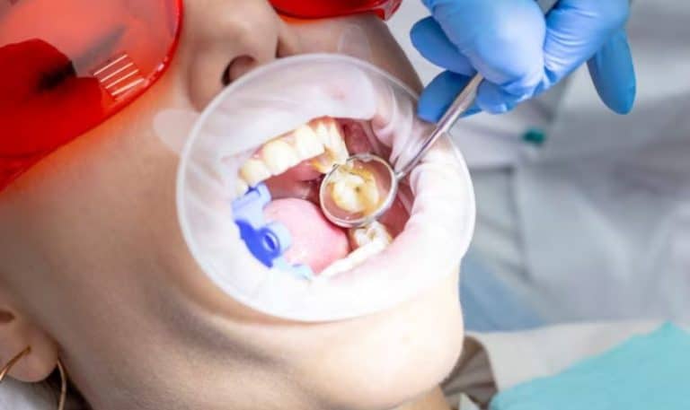 Understanding the Process of Same Day Root Canals in Staples Mill Richmond, VA