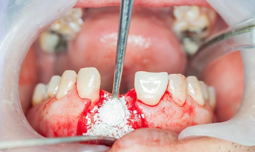 Dental Bone Graft