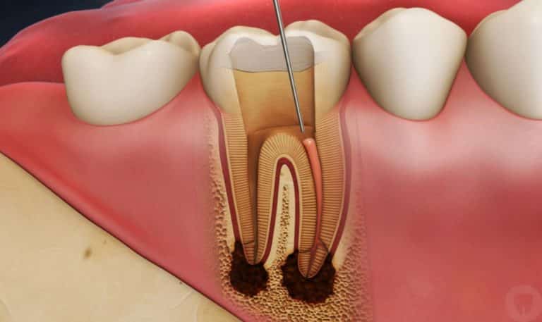 10 Measures You Need to Take After Your Root Canal