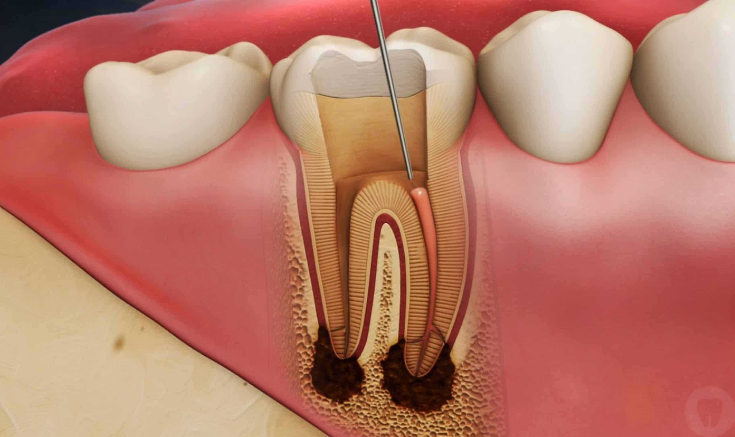 Essential Post Root Canal Care