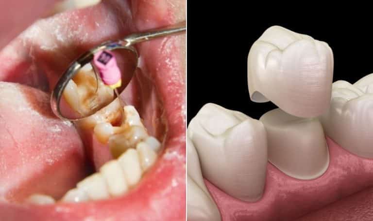 Can You Get A Root Canal And Crown On The Same Day?