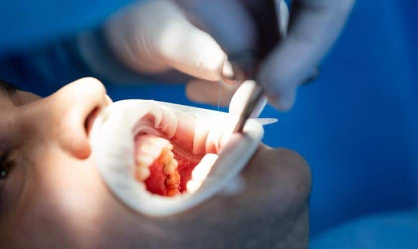 Wisdom Tooth Extraction Surgery
