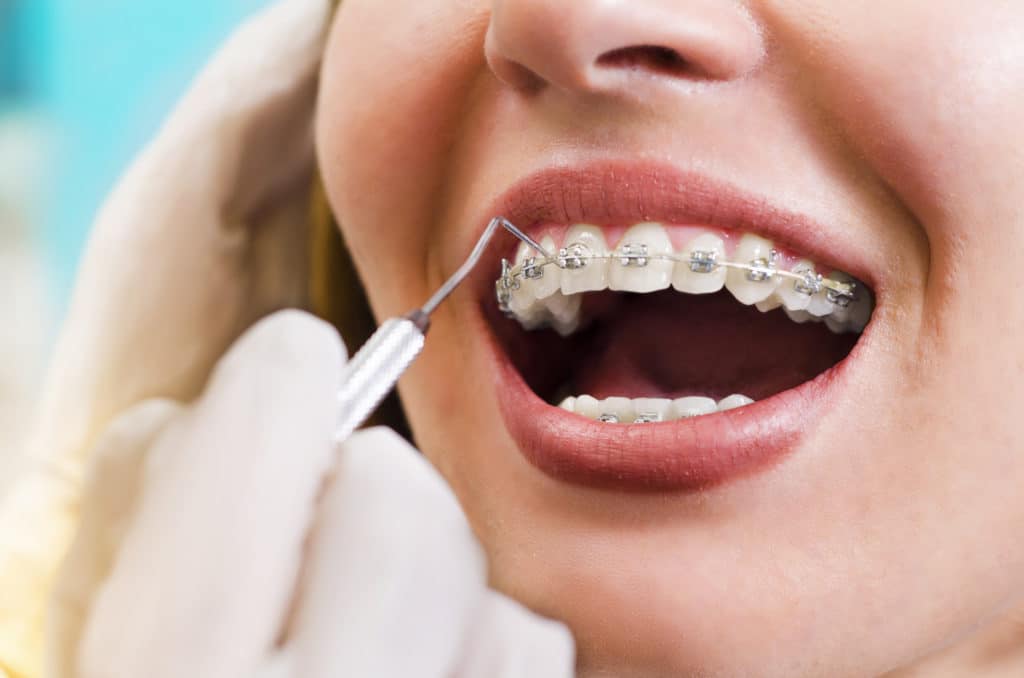 Can You Get Braces After A Gum Graft