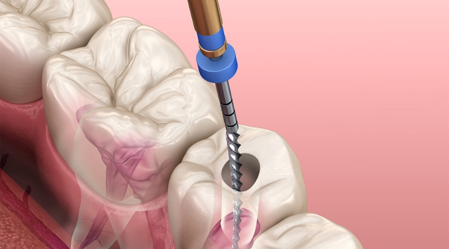 Common Signs You Need A Root Canal