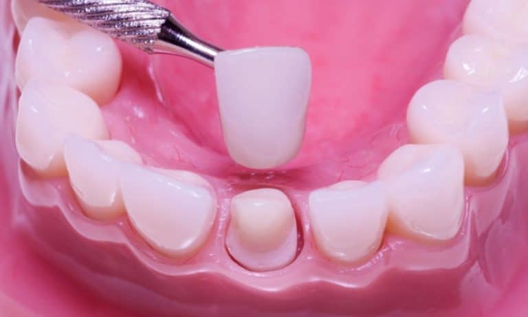 Your Dental Crown Broke: Here Are 5 Steps To Take Immediately