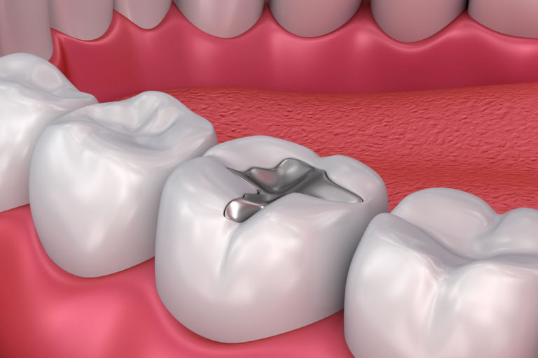 How To Recover Faster After Your Dental Fillings Procedure
