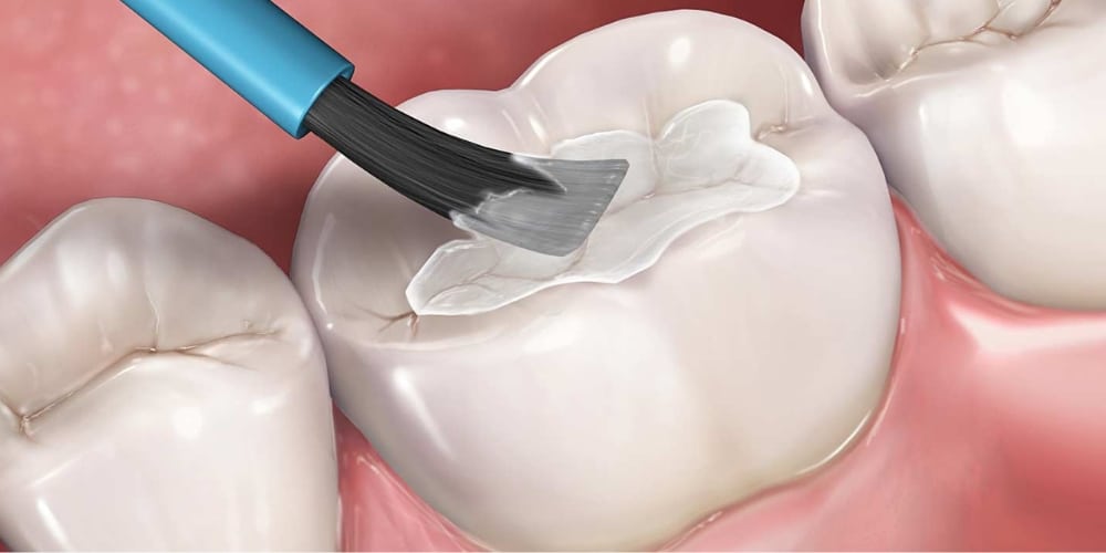 Dental Sealants Recovery