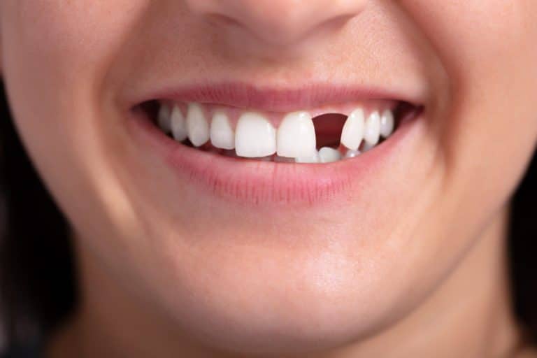 What Happens If You Lose An Adult Tooth?