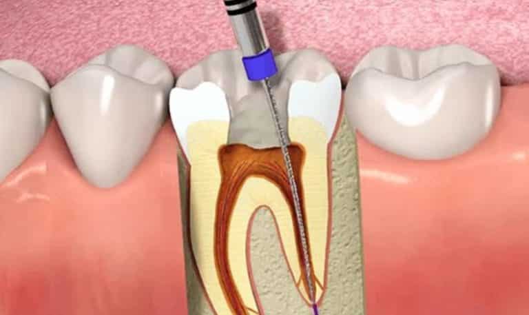 How to Find the Best Dentist for Root Canals in Northside Richmond, VA
