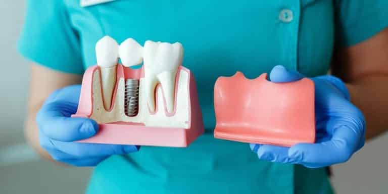 The Complete Guide To Understanding How Dental Implants Work