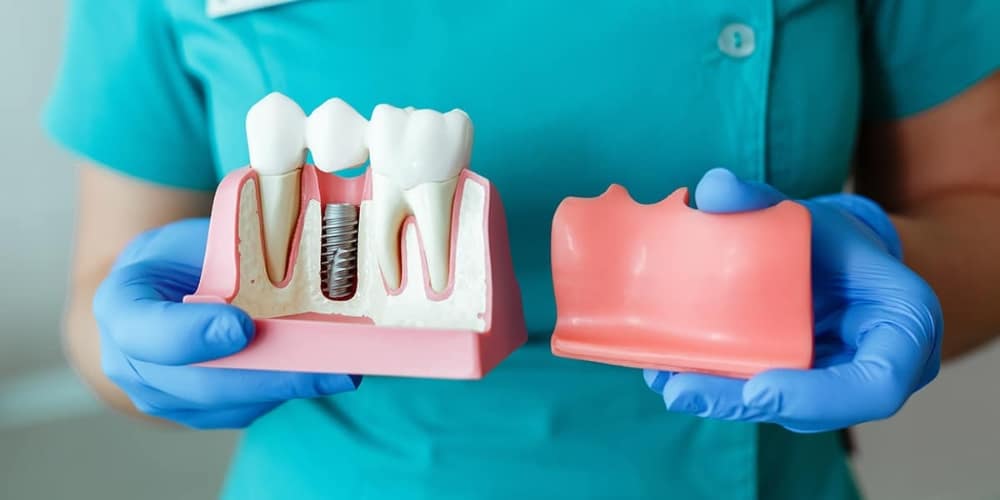 comprehensive guide on how dental implants work