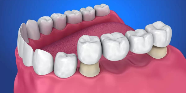 Dental Bridge Falls Out