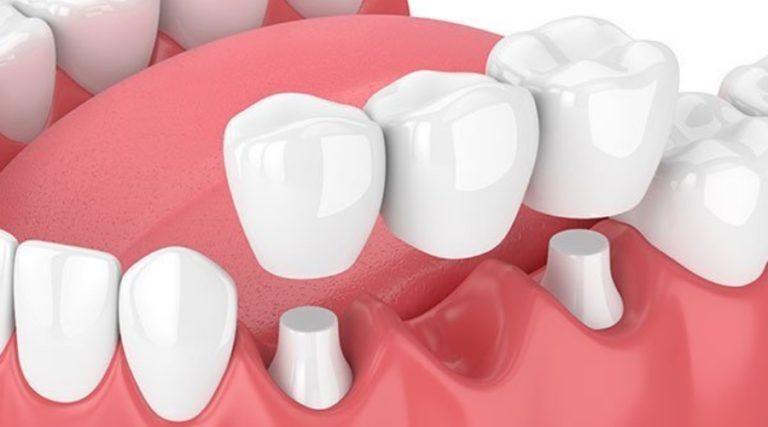 Feasibility of Dental Bridges