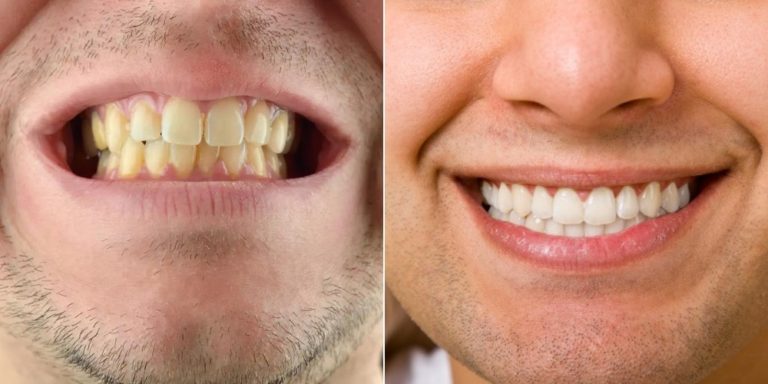 6 Ways To Remove Coffee Stains From Your Teeth