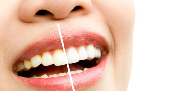 Teeth Whitening for Intrinsic Tooth Stains