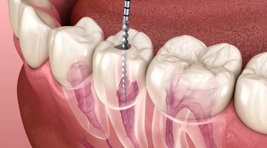 Vital Signs Of Root Canal Infection