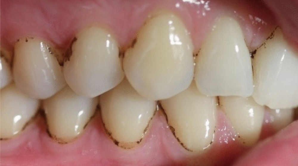 Black Spots On Teeth