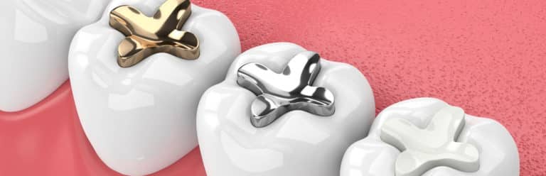 Can Tooth-Colored Fillings Improve Your Smile?